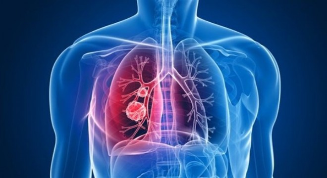 Verem akciğer kanseri ile karıştırılabilir