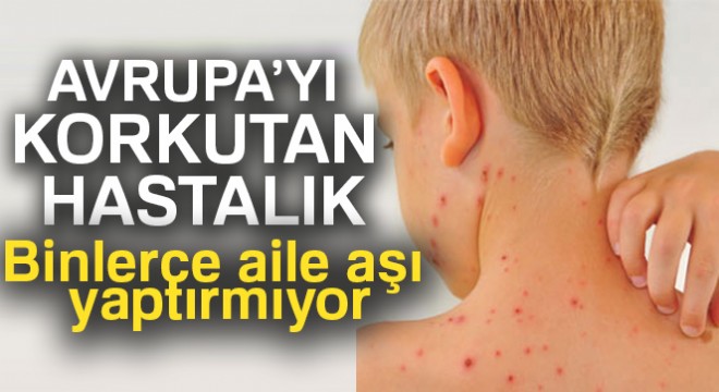 Avrupa da kızamığa yakalanan 35 çocuk öldü